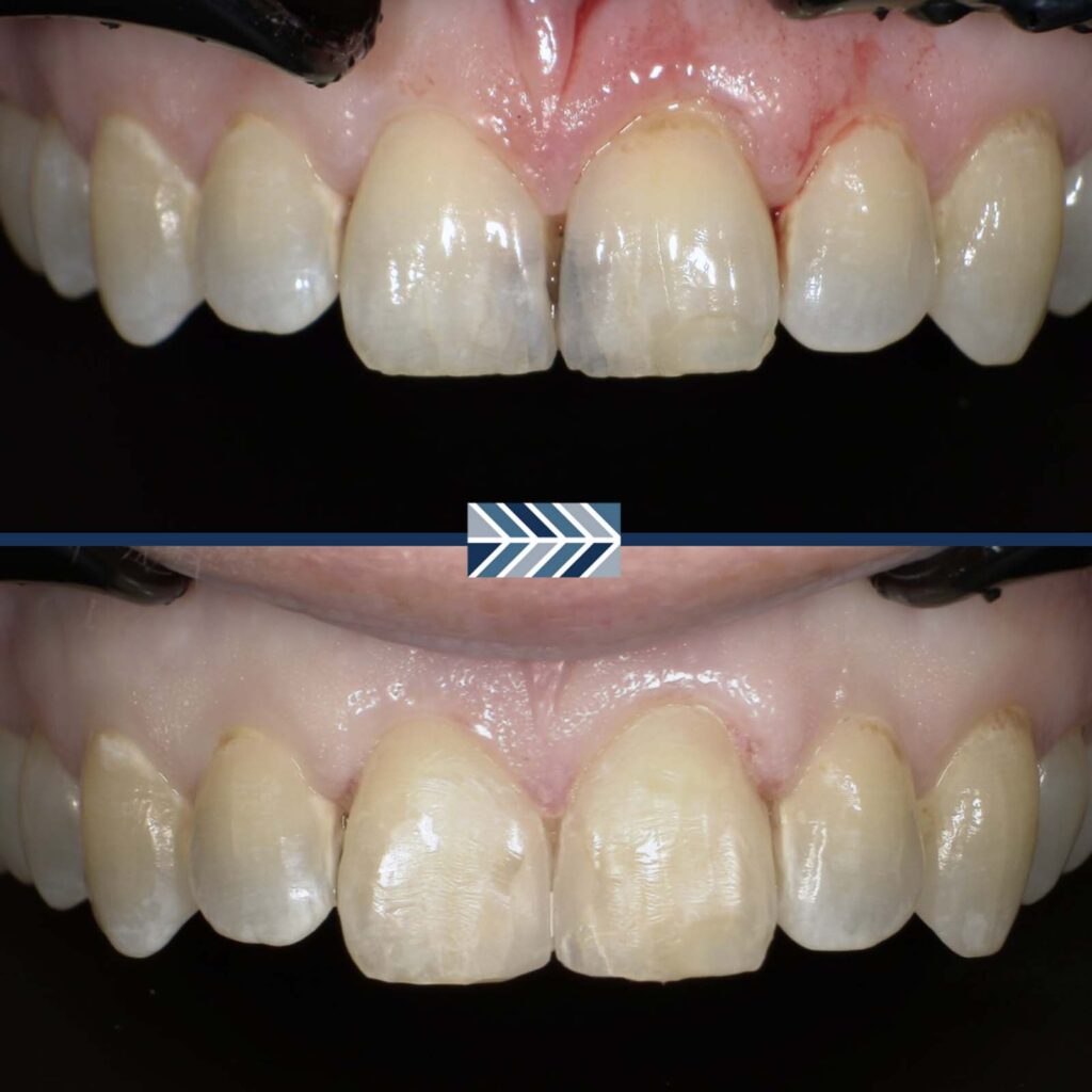 Side-by-side comparison of teeth before and after a dental procedure. The top image shows teeth with gaps, discoloration, and inflamed gums, while the bottom displays aligned, evenly colored teeth with healthy gums.