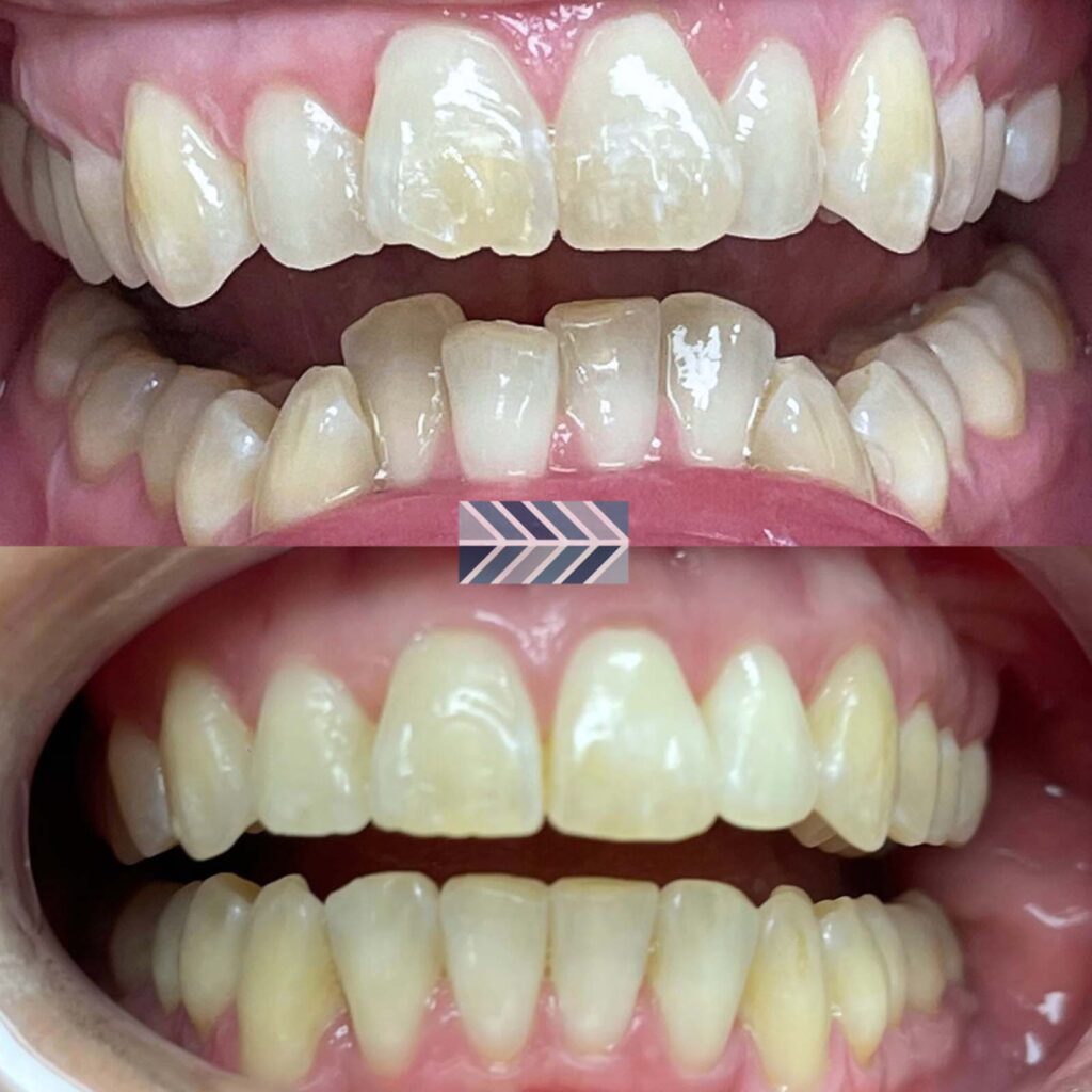 Comparison of teeth before and after whitening treatment. The top part shows teeth with discoloration and staining, while the bottom part displays brighter, evenly white teeth post-treatment.