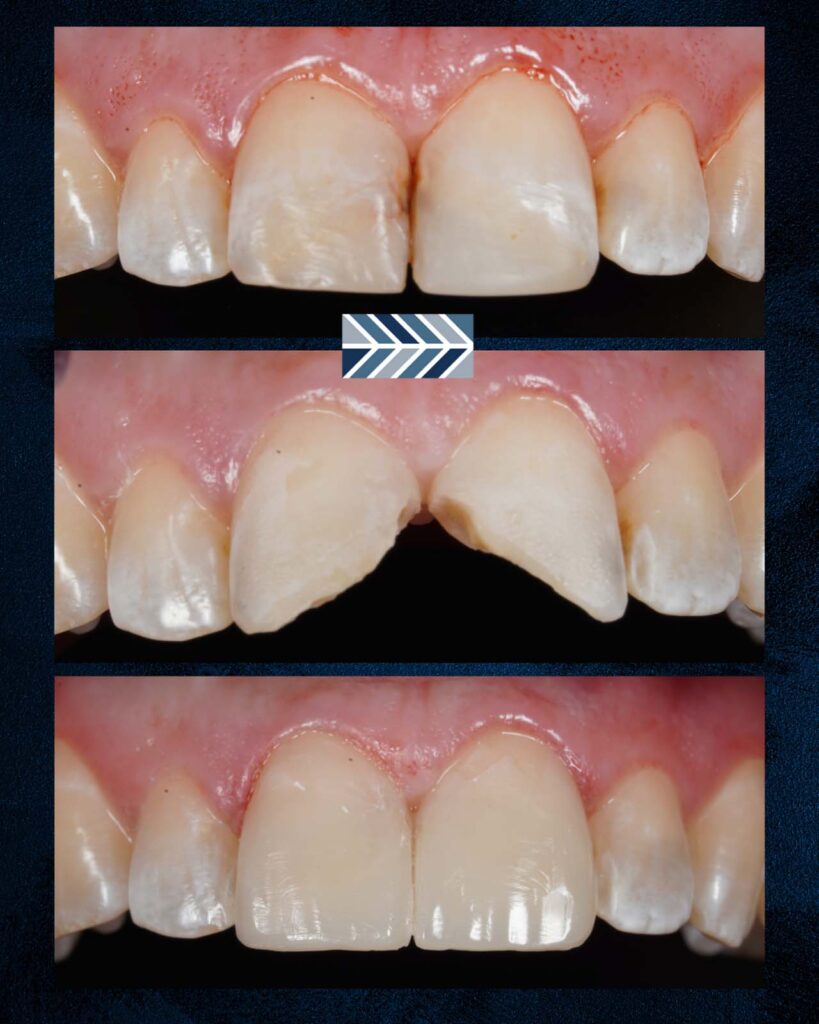 Sequence of three images showing teeth restoration. The top shows slight wear on central incisors, the middle displays chipped and broken teeth, and the bottom highlights fully repaired and healthy teeth after treatment.