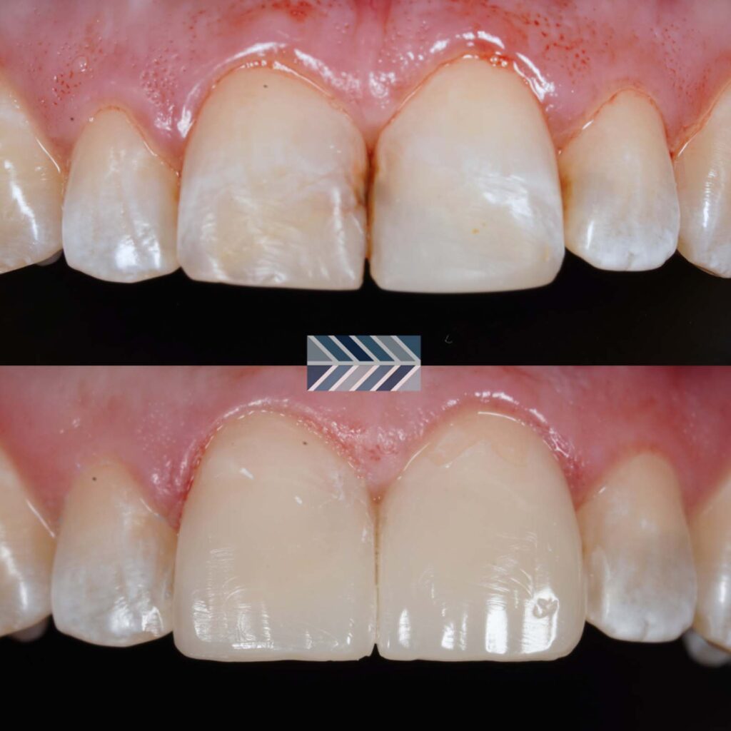 Comparison of teeth before and after cosmetic dental treatment. The top part shows teeth with wear, stains, and uneven edges, while the bottom part depicts whiter, smooth-edged teeth with improved symmetry post-treatment.