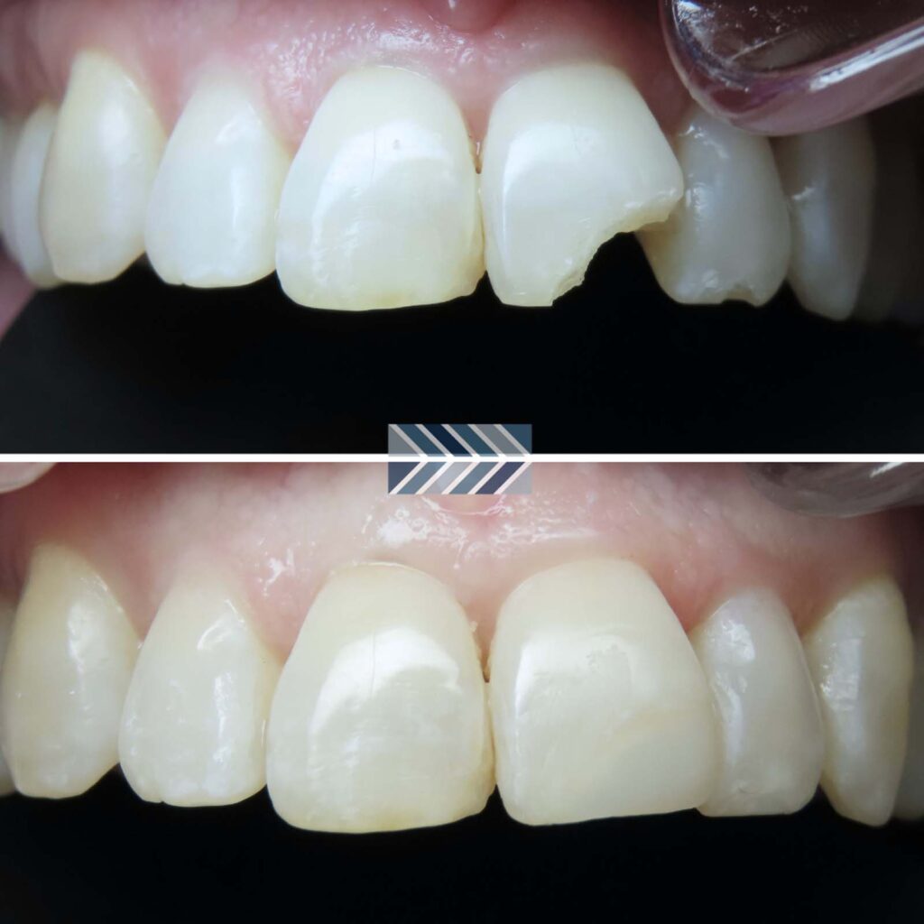 Two close-up views of upper front teeth before and after restoration. The top shows a chipped front tooth, while the bottom displays the same teeth with the chip repaired to look natural.