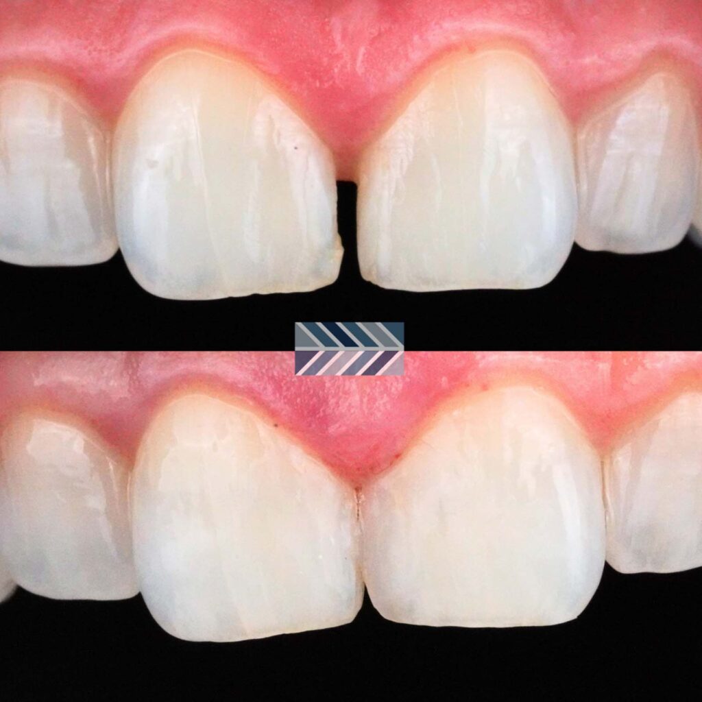 Close-up comparison of two upper front teeth before and after gap closure treatment. The top image shows a distinct gap, while the bottom displays the same teeth with the gap filled, likely through bonding or a similar dental procedure.